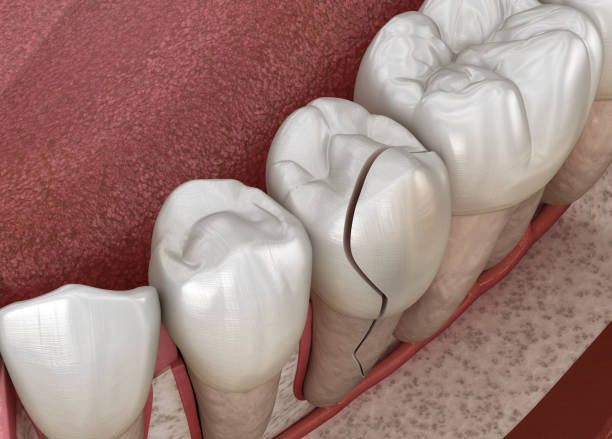 chipped tooth