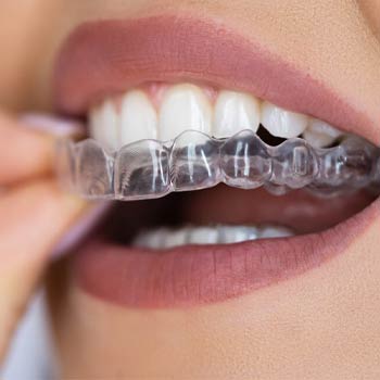 clear aligners
