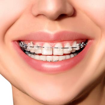 dental braces