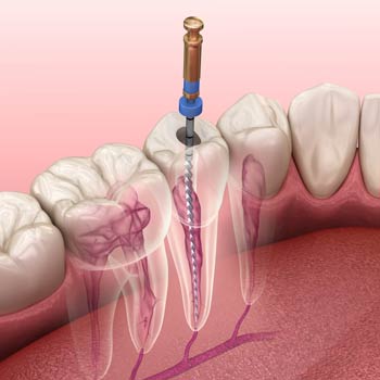 root canal treatment
