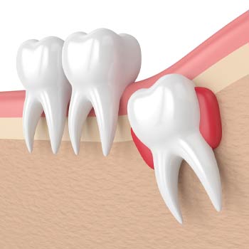 wisdom tooth removal